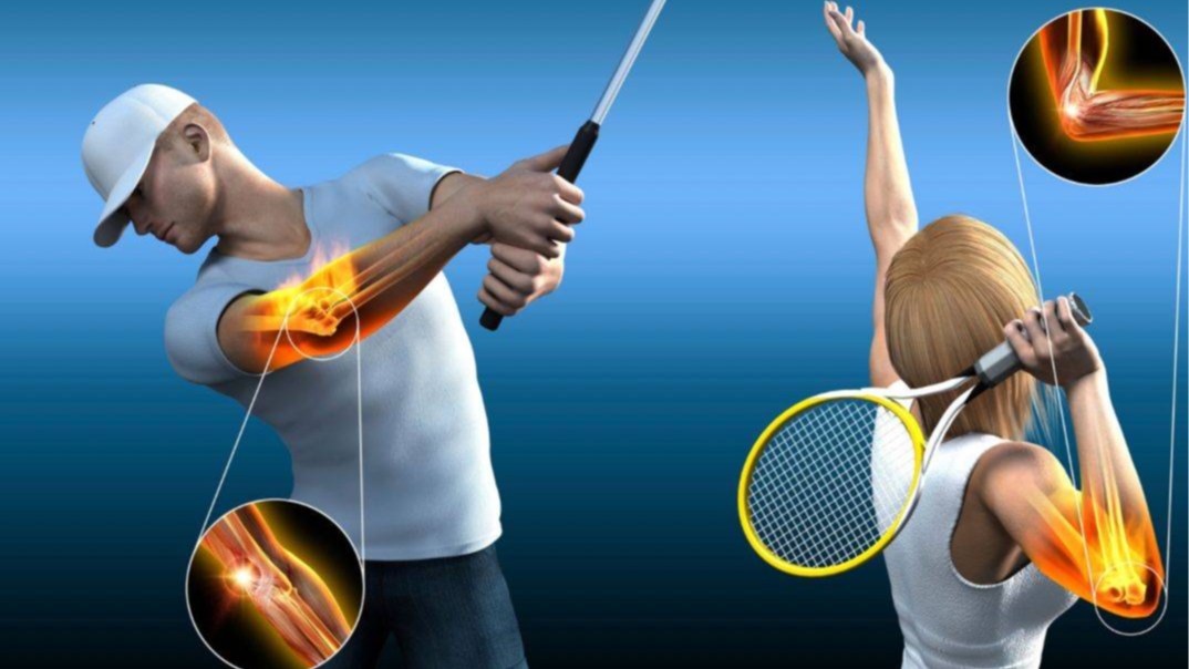 Treatment for tennis/golfer’s elbow