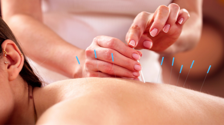Dry Needling
