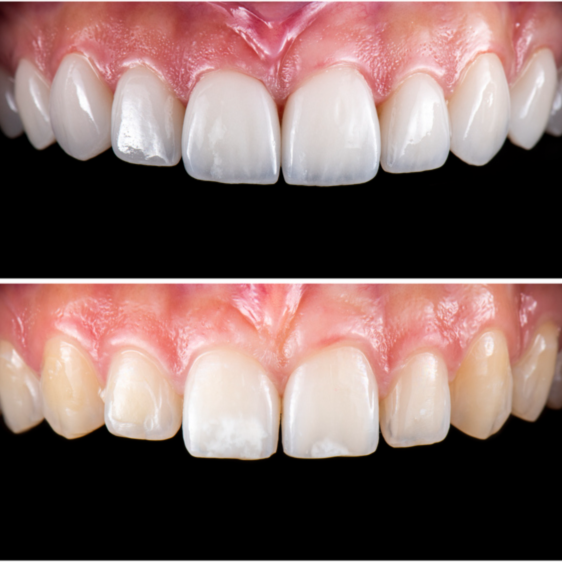 Emax Veneer