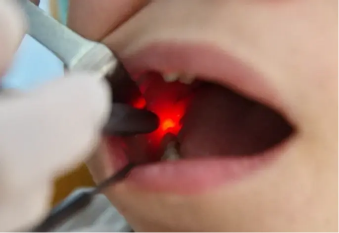 Save 20% on Tooth Installation (Zirconium) | PricelessMed
