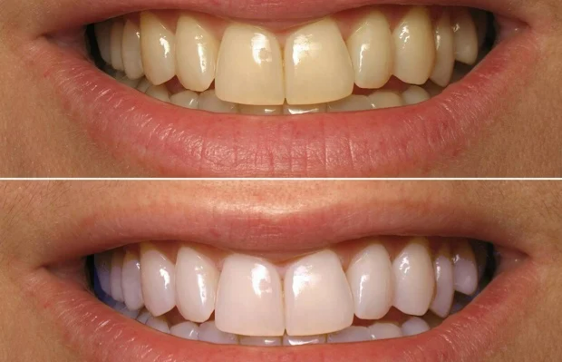 Normal Teeth Cleaning - 57% OFF | PricelessMed