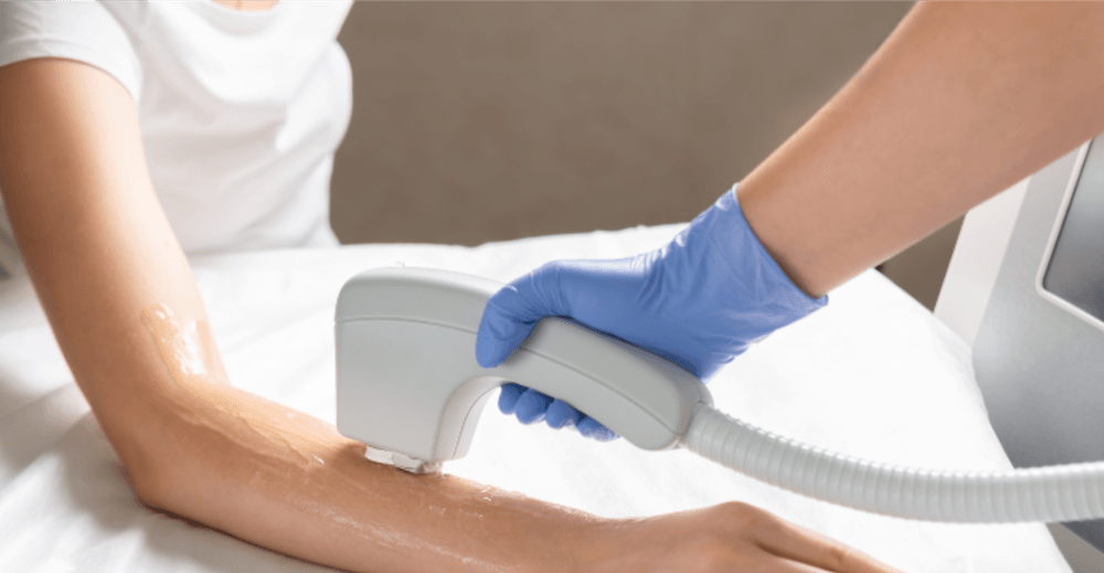 Laser Hair Removal Candela - Women (Any Body Part) Discou...