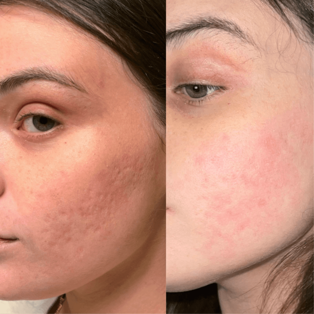 Fractional Laser Care - Mrs. Dina