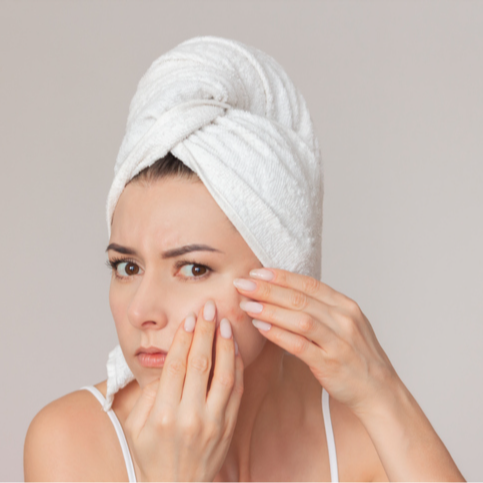 Acne TCA Peel - 15% OFF | PricelessMed