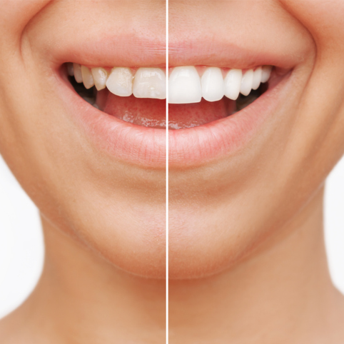 Veneers [Cost Range Between AED 5,000-AED 15,000] Discoun...