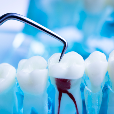 Anterior Root Canal Per Tooth - 15% OFF | PricelessMed