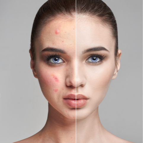 DNA Test: Acne Profile  Discount | PricelessMed