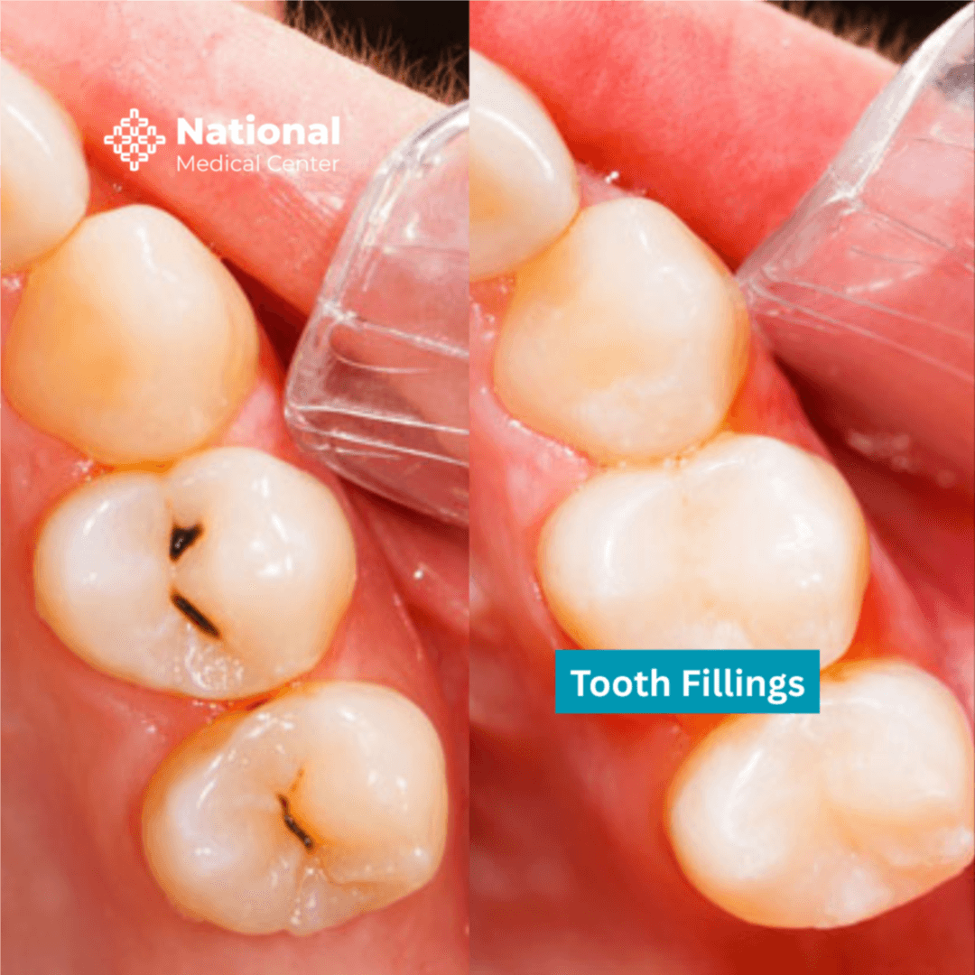 Save 50% on Cosmetic Filling | PricelessMed
