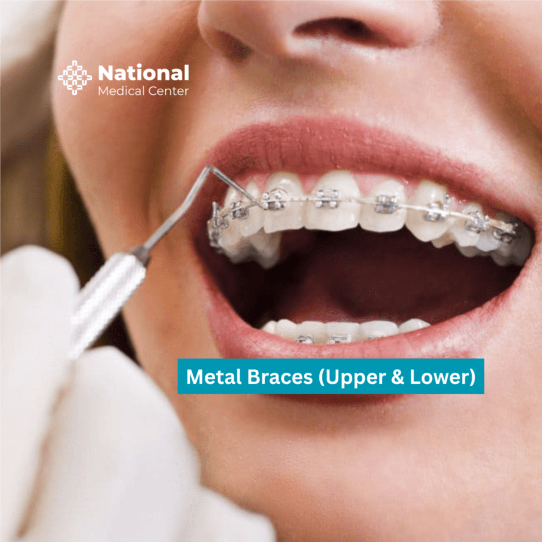  Metal Braces  - 41.6666% OFF | PricelessMed